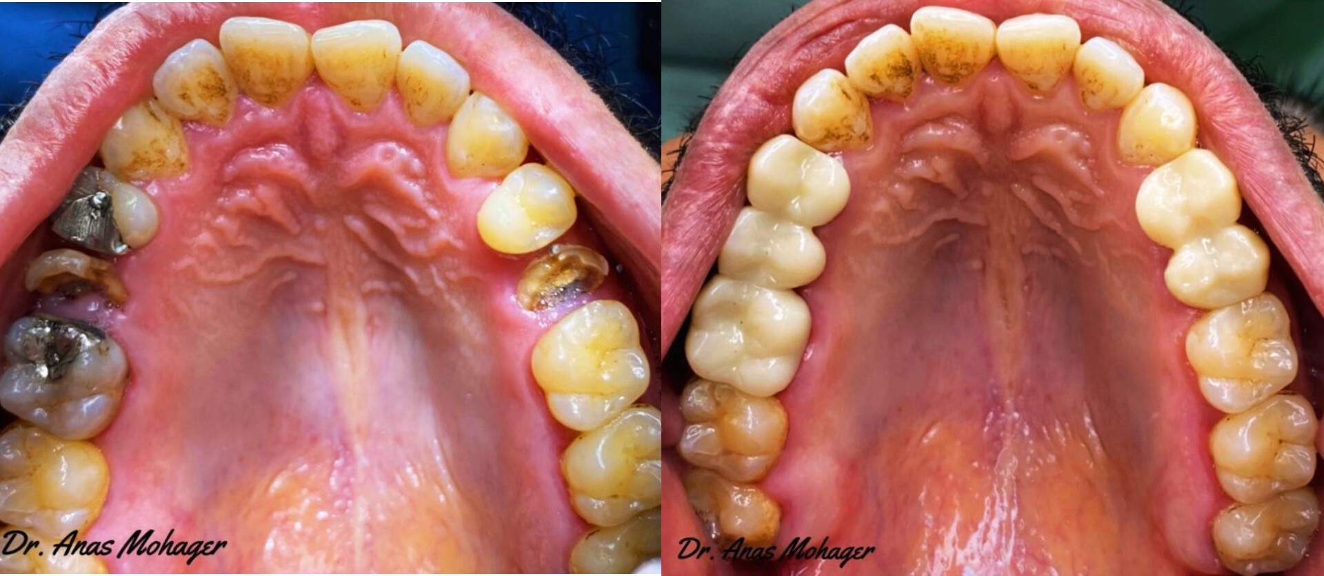 استبدال التركيبات المعدنية بتيجان زيركون تجميلية